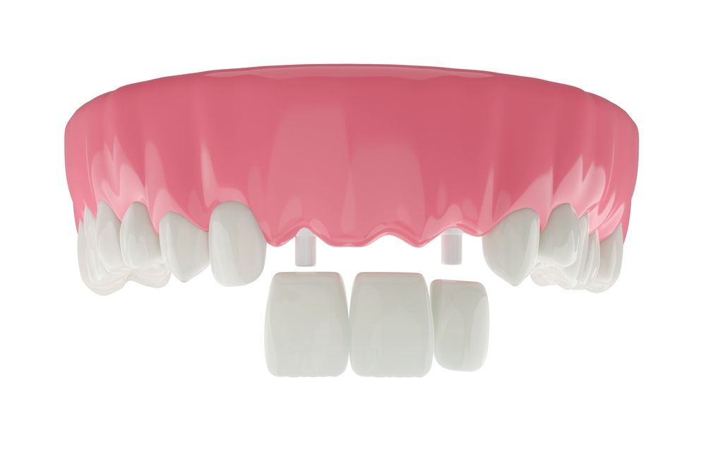 Should I Get Crowns on My Front Teeth?